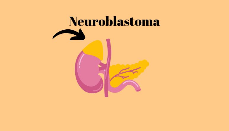 Illustration: Neuroblastoma