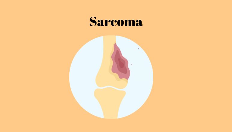 Illustration: Sarcoma