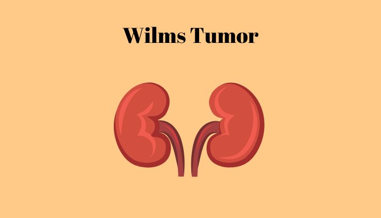 Illustration: Wilms tumour