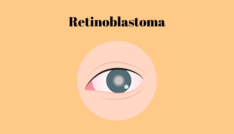 Illustration: Retinoblastoma